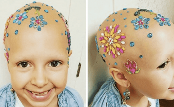Little Girl With Alopecia Rocks “Crazy Hair Day” At School Says “Now I Love Being Bald”