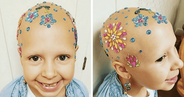Little Girl With Alopecia Rocks “Crazy Hair Day” At School Says “Now I Love Being Bald”