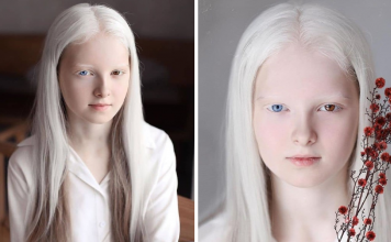 Photographer Captured The Unique Beauty Of A Girl With Albinism And Heterochromia