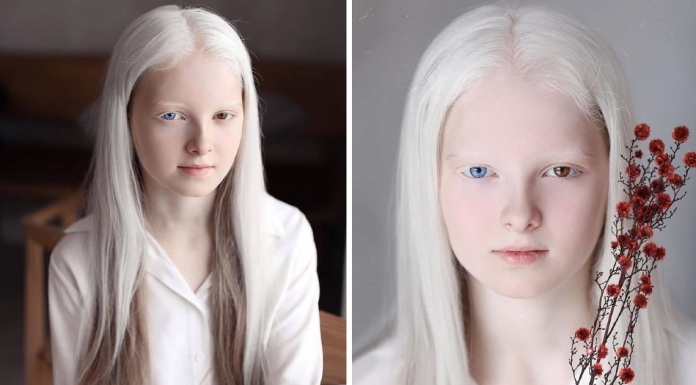Photographer Captured The Unique Beauty Of A Girl With Albinism And Heterochromia